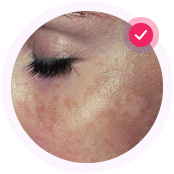 Пятна после беременности